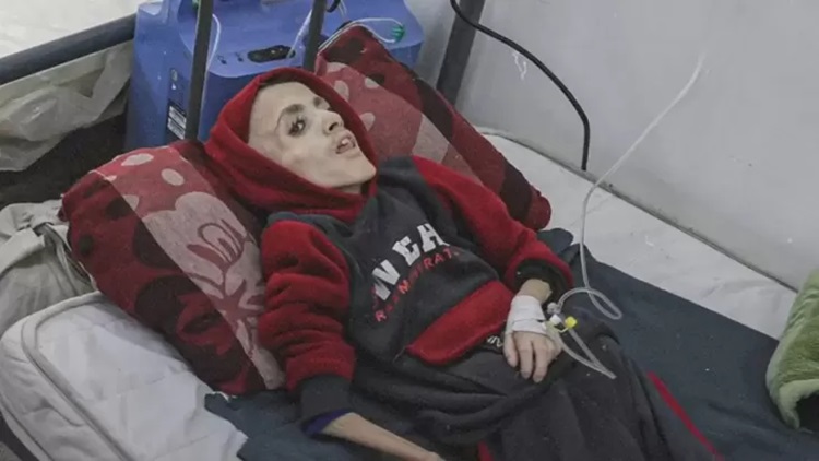  Innalillahi, Yazan Bocah Gaza Meninggal Dunia karena Kelaparan dan Malanutrisi